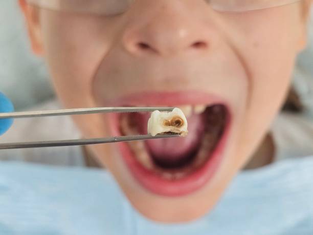 Best Emergency Treatment for Dental Infections or Abscesses in Sconsin Rapids, WI